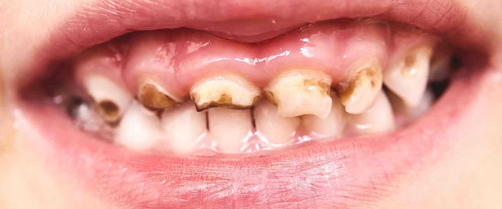 What happens when a child has rotten teeth?