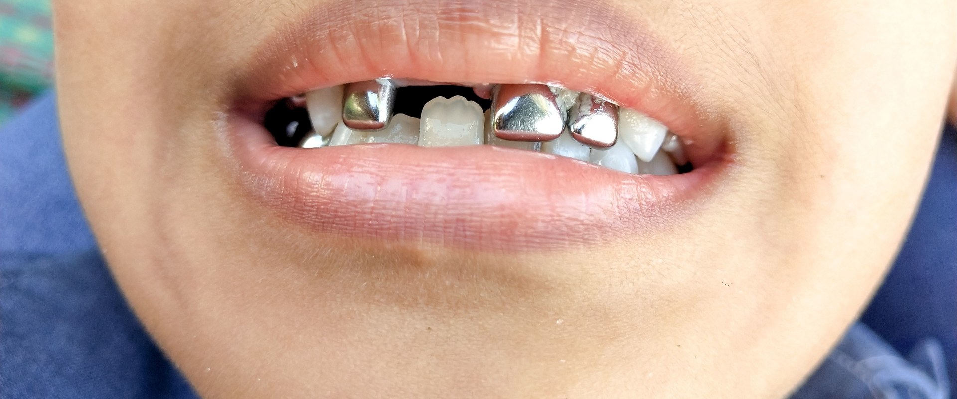 How long do caps on baby teeth last?