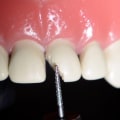 Can Dentist Fix Any Teeth