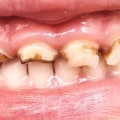 What happens when a child has rotten teeth?