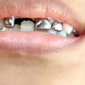 How long do caps on baby teeth last?