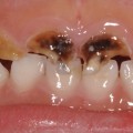 What Are the Signs and Symptoms of Tooth Decay in Children?