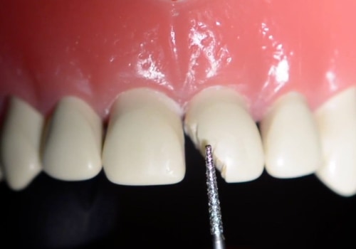 Can Dentist Fix Any Teeth