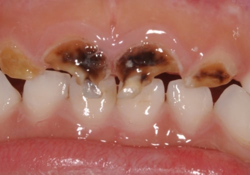 What Are the Signs and Symptoms of Tooth Decay in Children?